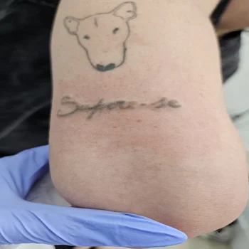 Laser Tattoo Removal Doral 